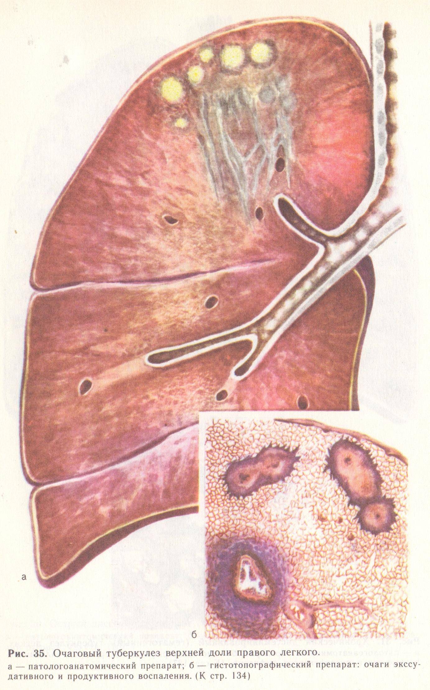 Лечение от туберкулеза в домашних условиях – можно ли вылечить дома