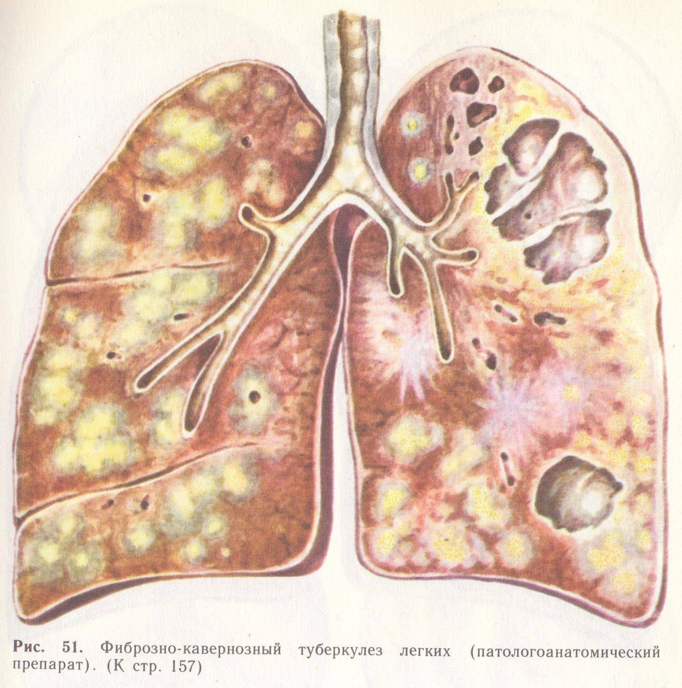 Картина фиброзных изменений. Фиброзно-кавернозный туберкулез. Кавернозный туберкулез каверна. Инфильтративный туберкулез макропрепарат. Фиброзо кавернозный туберкулёз.