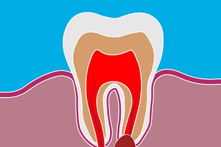 Гранулема или киста зуба
