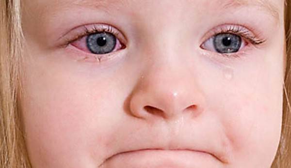 Конъюнктивит при простуде у ребенка лечение