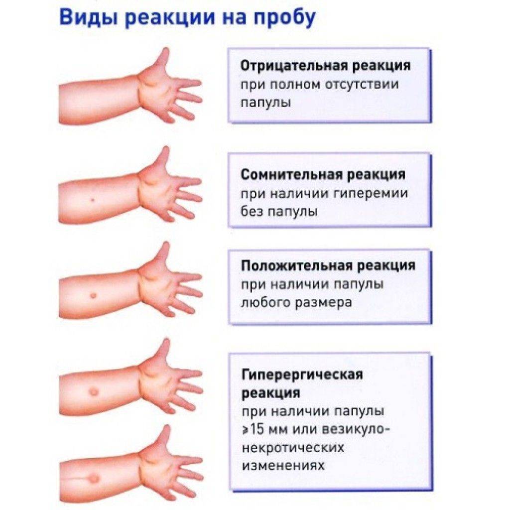 В детский сад без манту и фтизиатра - заключение фтизиатра об отсутствии заболевания туберкулезом - запись пользователя нaтaшa (poli11543) в сообществе мы против прививок! в категории манту - babyblog.ru