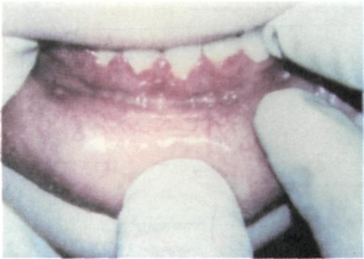 Потемнение эмали зуба