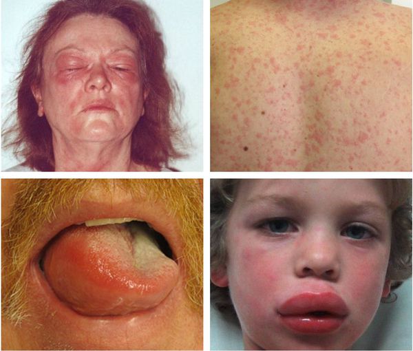 Лекарственная аллергия - симптомы, причины и лечение лекарственной аллергии