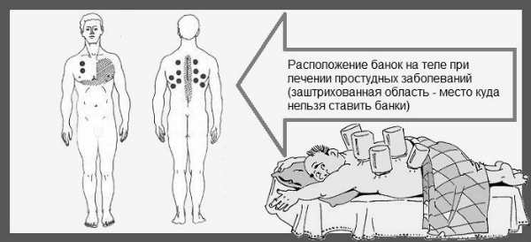 Банки на позвоночник: противопоказания