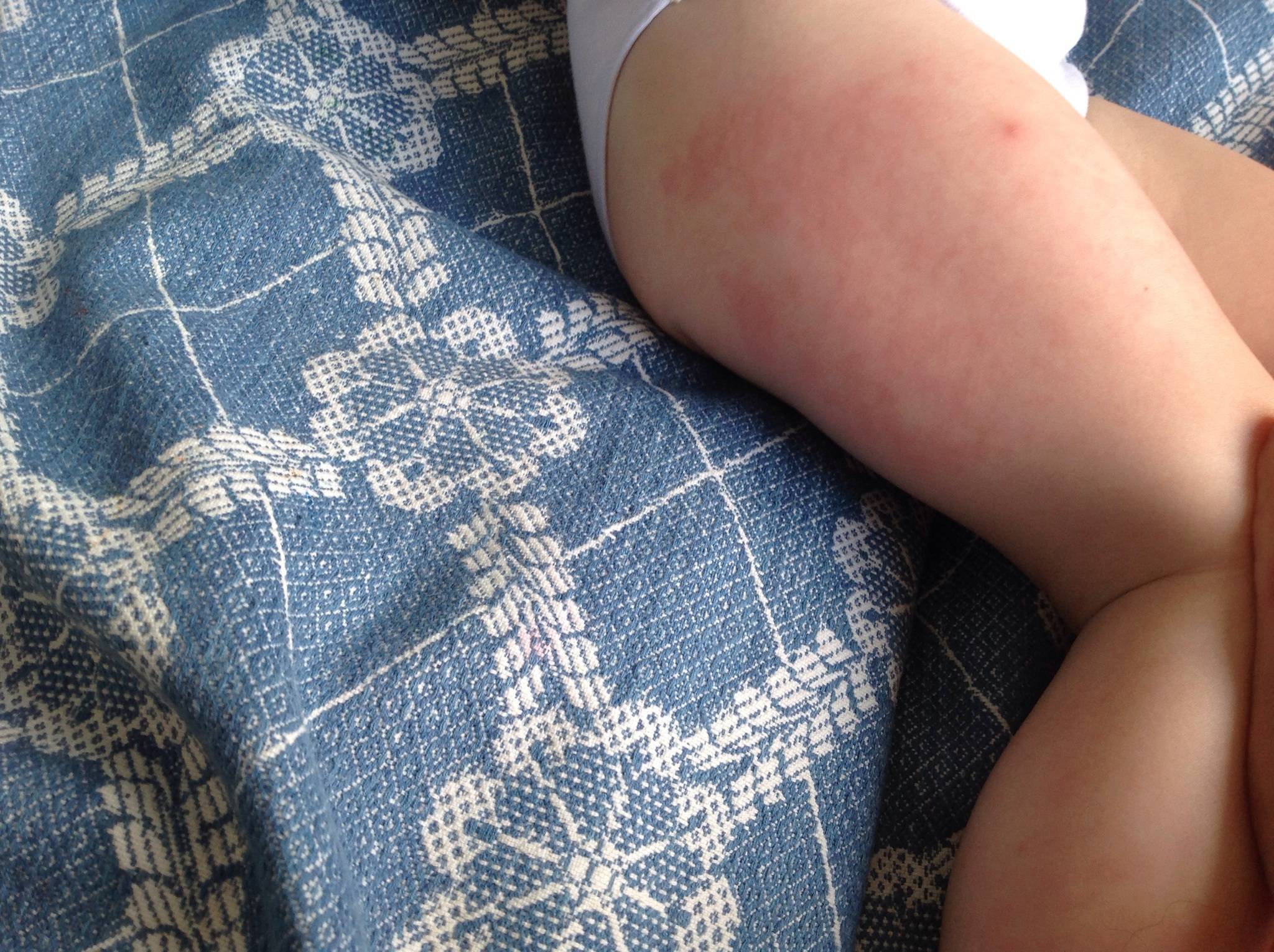 После прививки акдс уплотнение и покраснение в месте укола у ребенка