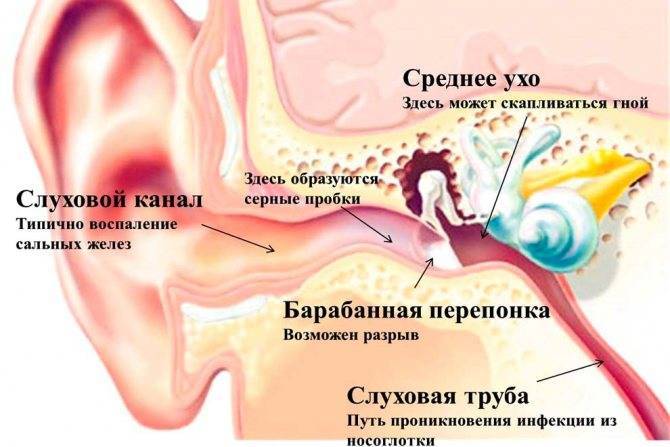 Лечение отита, симптомы и лечение острого среднего уха у взрослых, эффективное медикаментозное лечение