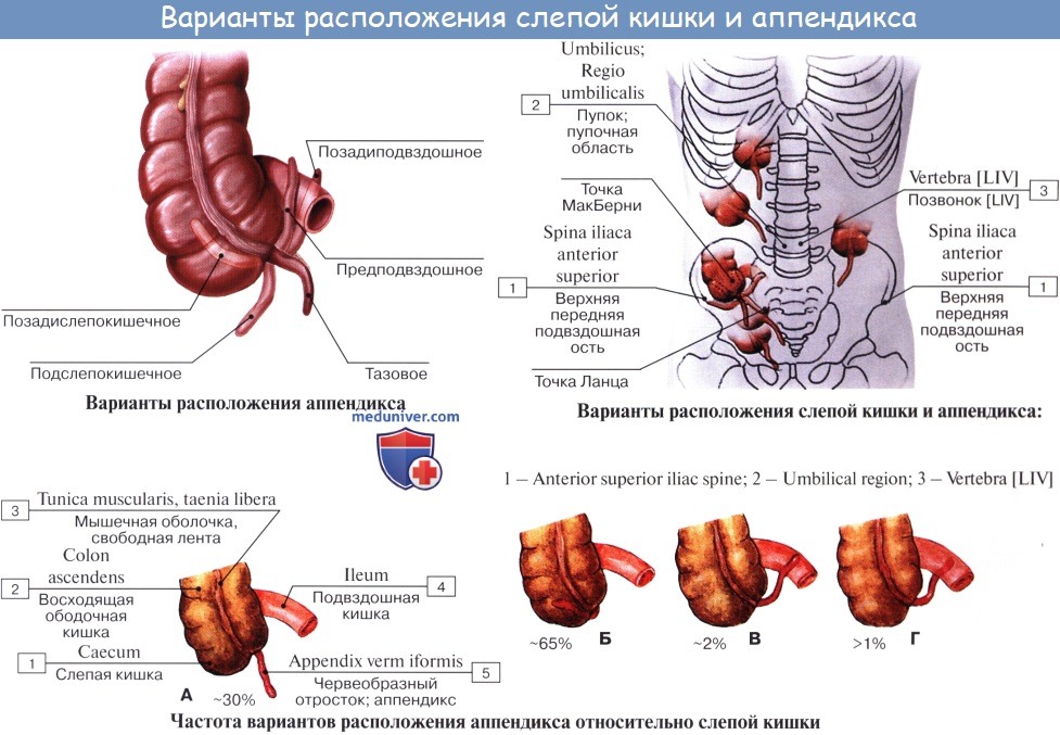 Особенности клинической картины острого аппендицита при тазовом расположении червеобразного отростка