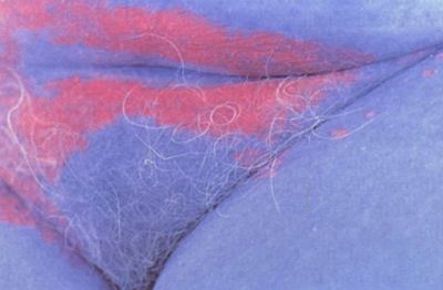 Паховая эпидермофития у мужчин и женщин: фото, симптомы и лечение грибка в паху