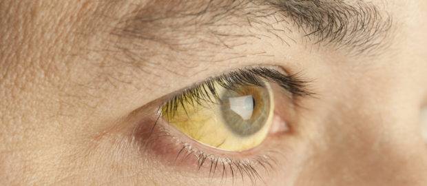 Пожелтевшие белки глаз при отравлении
