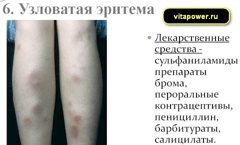 Узловатая эритема на ногах — диагноз или симптом