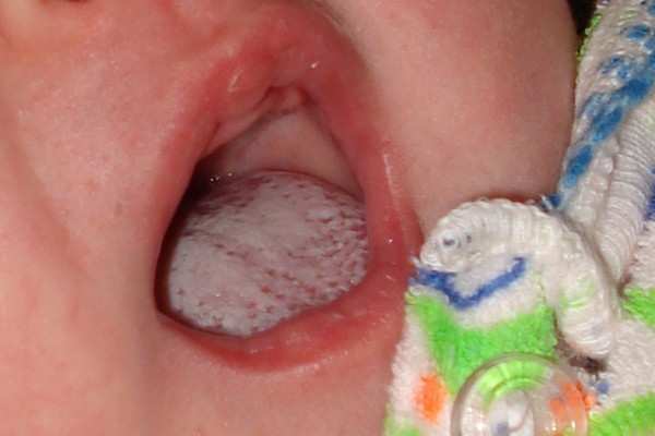 Капли кандид для новорожденных для полости рта: инструкция по применению