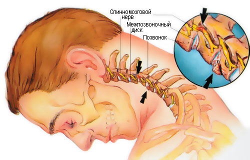 Болит голова и сзади шея: причины, диагностика и методы лечения