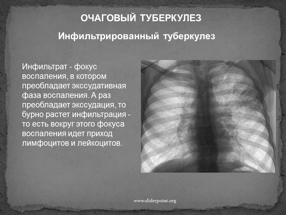 Заразен ли туберкулез для окружающих или нет