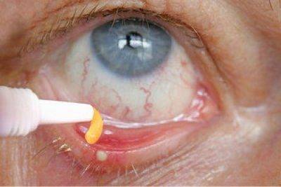 Тетрациклиновая глазная мазь: инструкция по применению для детей и взрослых, как наносить тетрациклиновую мазь для глаз