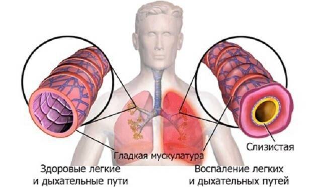 Прикорневая пневмония: признаки и лечение