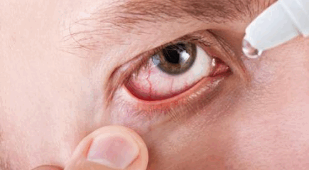 Демодекоз глаз (клещ демодекс на веках): симптомы и лечение