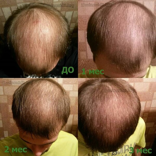 Миноксидил для роста волос: как применять средство, отзывы с фото до и после, цена