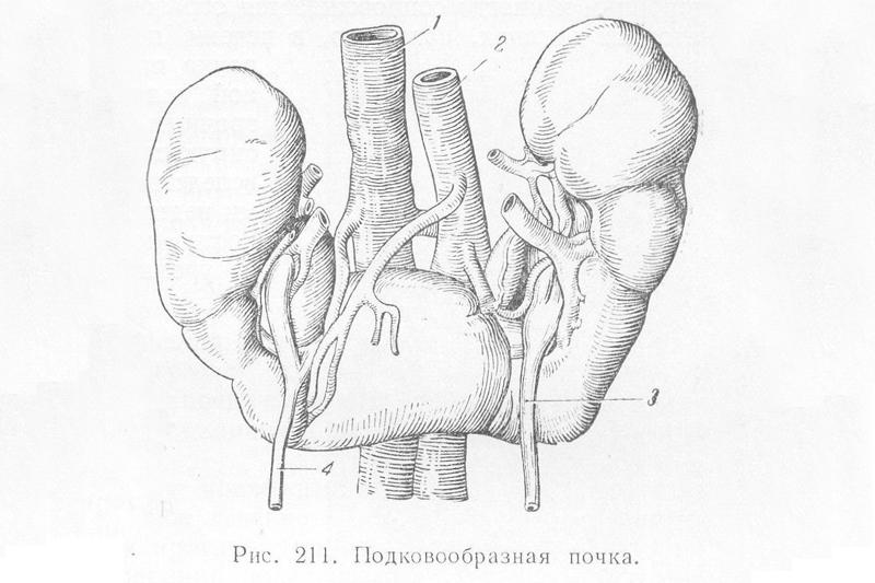 Подковообразная почка у ребенка чем опасна