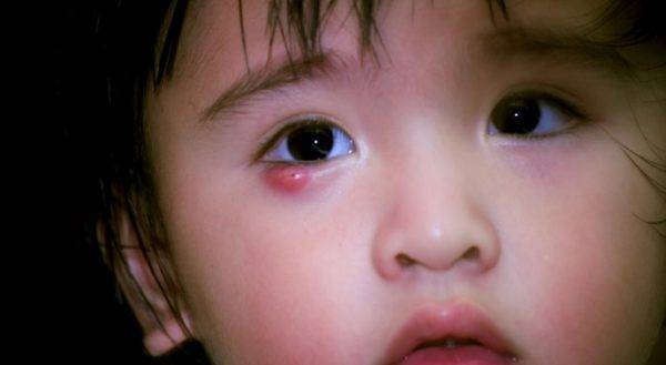 Ячмень на глазу у ребенка: 8 причин появления, 3 главных симптома, 7 правил лечения и 6 мер профилактики