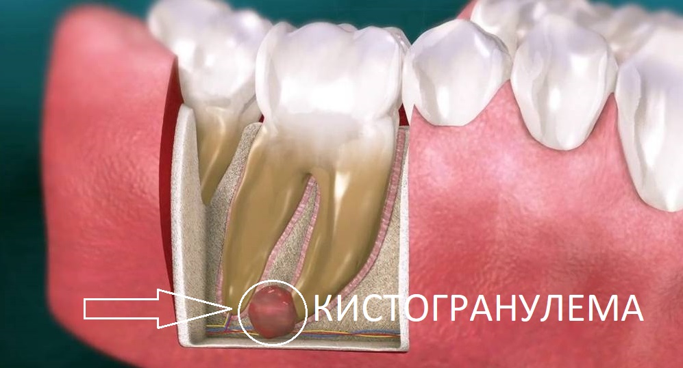 Как лечить кисту и гранелему зуба: рекомендации врачей
