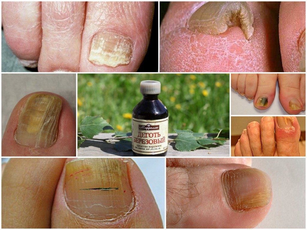 Грибок ногтей на ногах: лучшее средство для лечения,таблетки,эффективные лекарства, отзывы