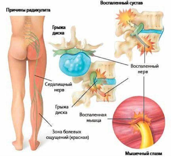 Карипазим при грыже позвоночника отзывы цены
