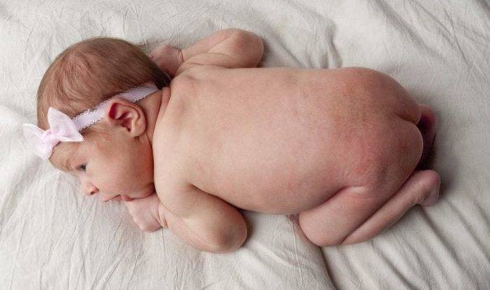 Красная попа вокруг ануса у новорожденного и грудничка