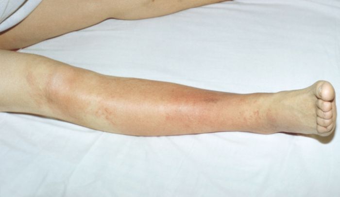 Рожа на ноге, лице. рожистое воспаление кожи - лечение и симптомы болезни
