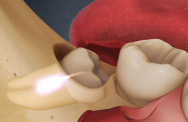 Сложное удаление зуба мудрости – нюансы проведения операции и возможные осложнения