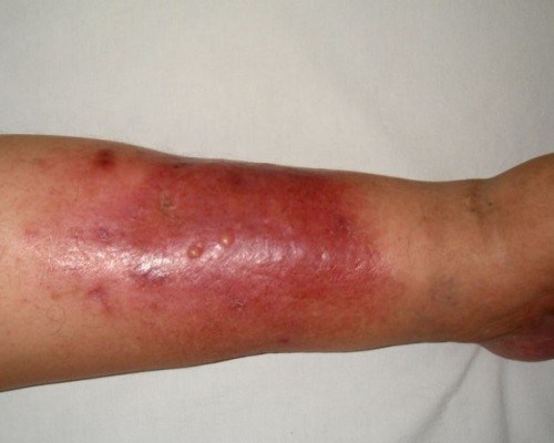 Рожистое воспаление кожи – что это за болезнь, как ее выявить и правильно лечить?