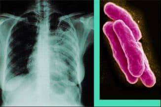 Как лечить открытую форму туберкулеза народными средствами