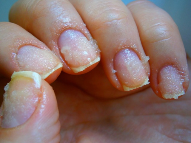 Почему слоятся ногти на руках: причины и лечение в домашних условиях