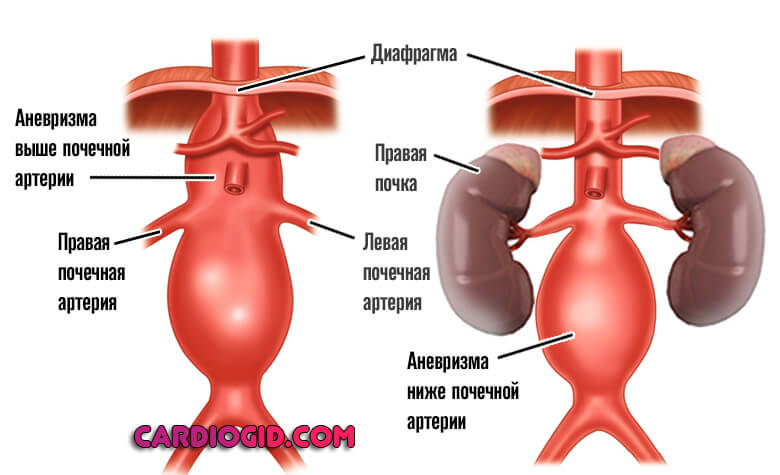 Как проводится обследование при подозрении на аневризму аорты в брюшной полости