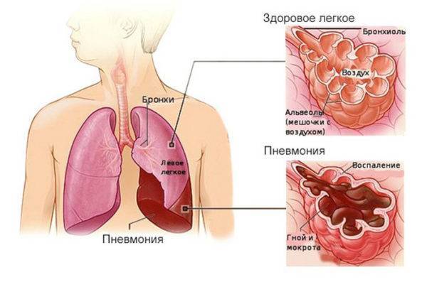 Симптомы и лечение пневмонии с кашлем, но без повышенной температуры