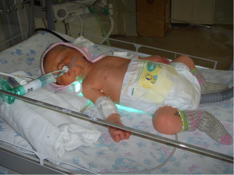 Последствия гипоксии у новорожденного при родах, нарушения психического развития. лечение