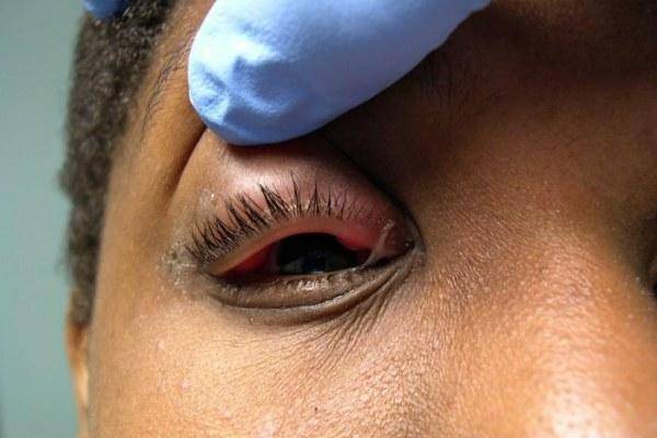 Аллергия глаза чешутся и опухают веки