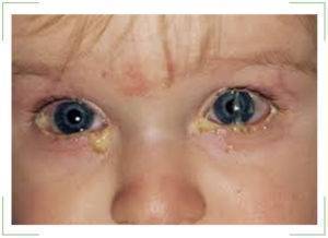 Заразен конъюнктивит у детей или нет, через сколько дней можно заразиться повторно