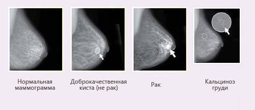 Узи или маммография- что лучше?