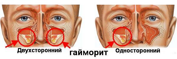 Гайморовы пазухи картинка