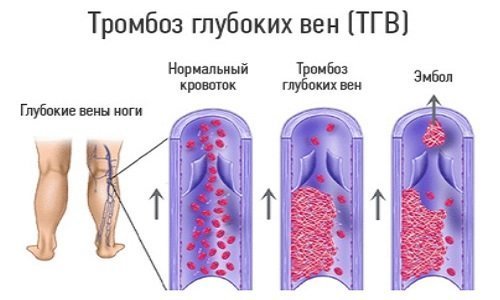 Тромбоэмболия: виды, причины, симптомы артериальной и венозной, лечение