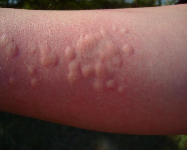 Аллергическая крапивница — причины, симптомы, диагностика и лечение — симптомы
