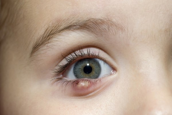 7 врожденная и приобретенная патология органов зрения