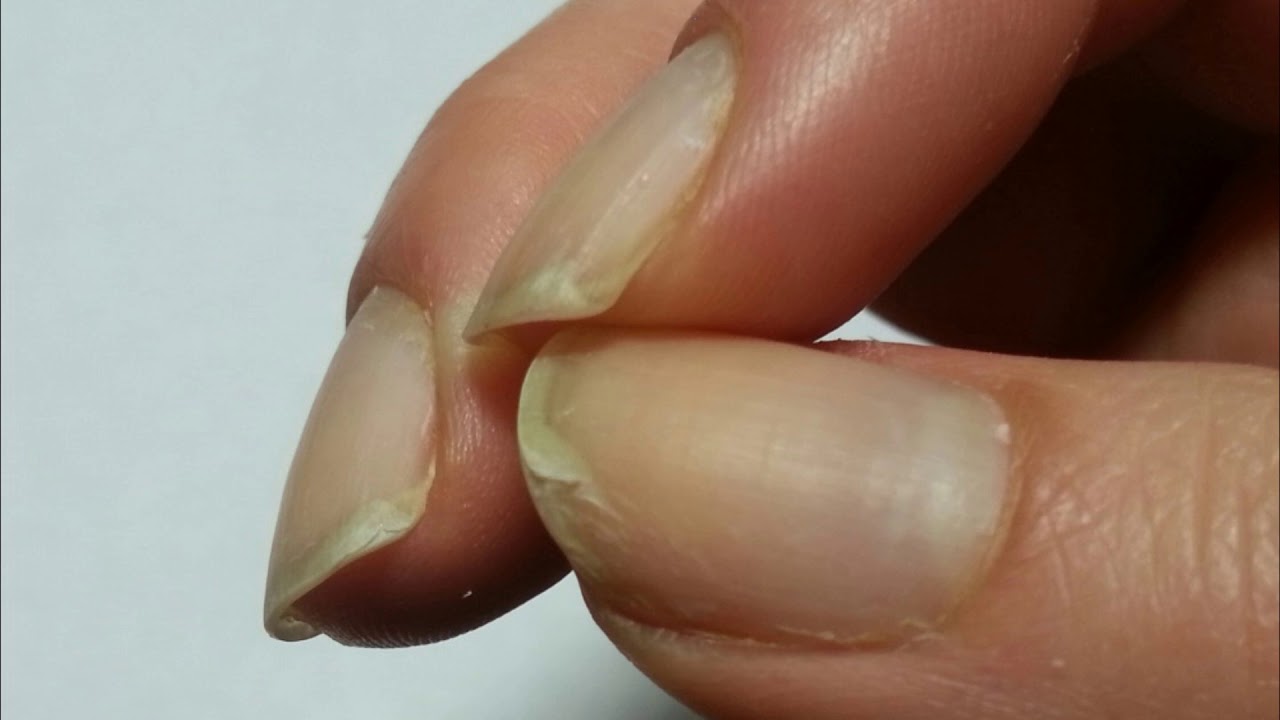 Почему слоятся ногти на руках: причины и лечение в домашних условиях