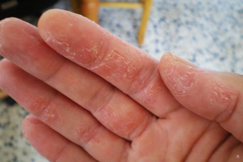 Экзема на руках – причины, симптомы и эффективное лечение болезни