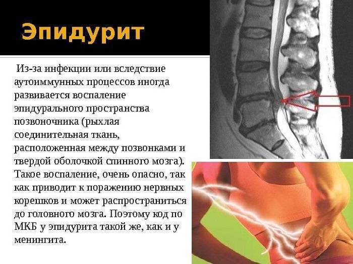 Что такое эпидурит, каковы его симптомы?