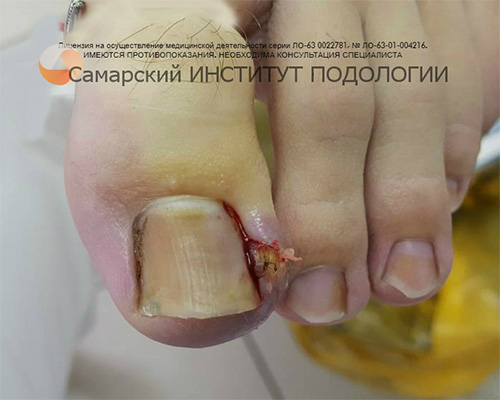 Эффективные способы удаления ногтя на пальце ноги