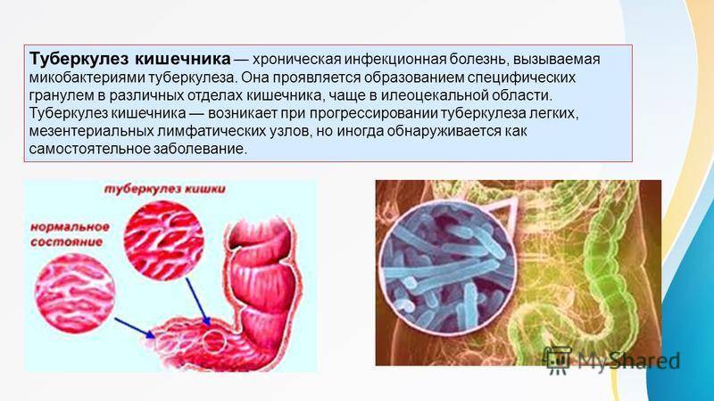 Туберкулез кишечника картинки