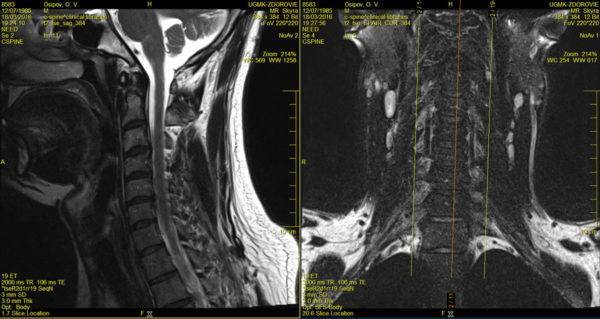 Что такое мрт шейного отдела позвоночника с контрастированием