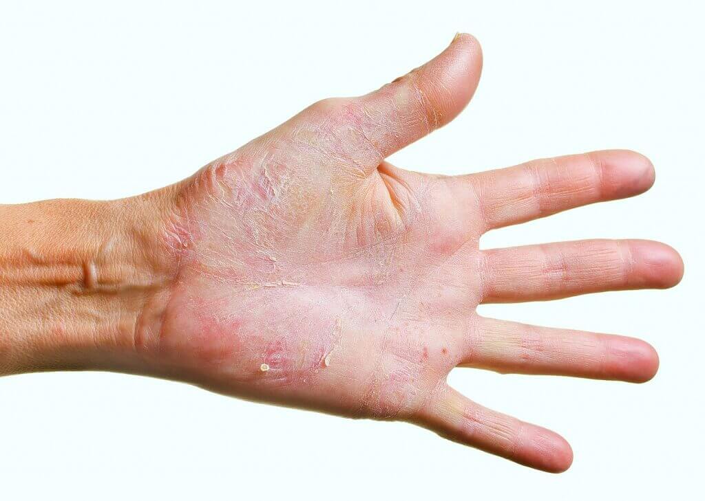 Грибок кожи на теле: симптомы, как и чем лечить