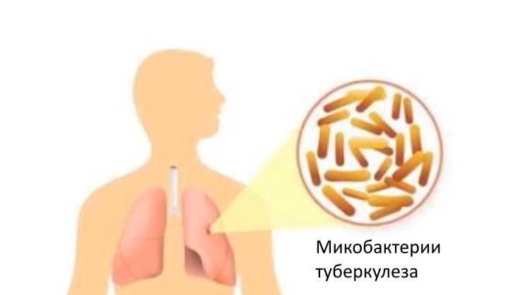Первые симптомы туберкулеза